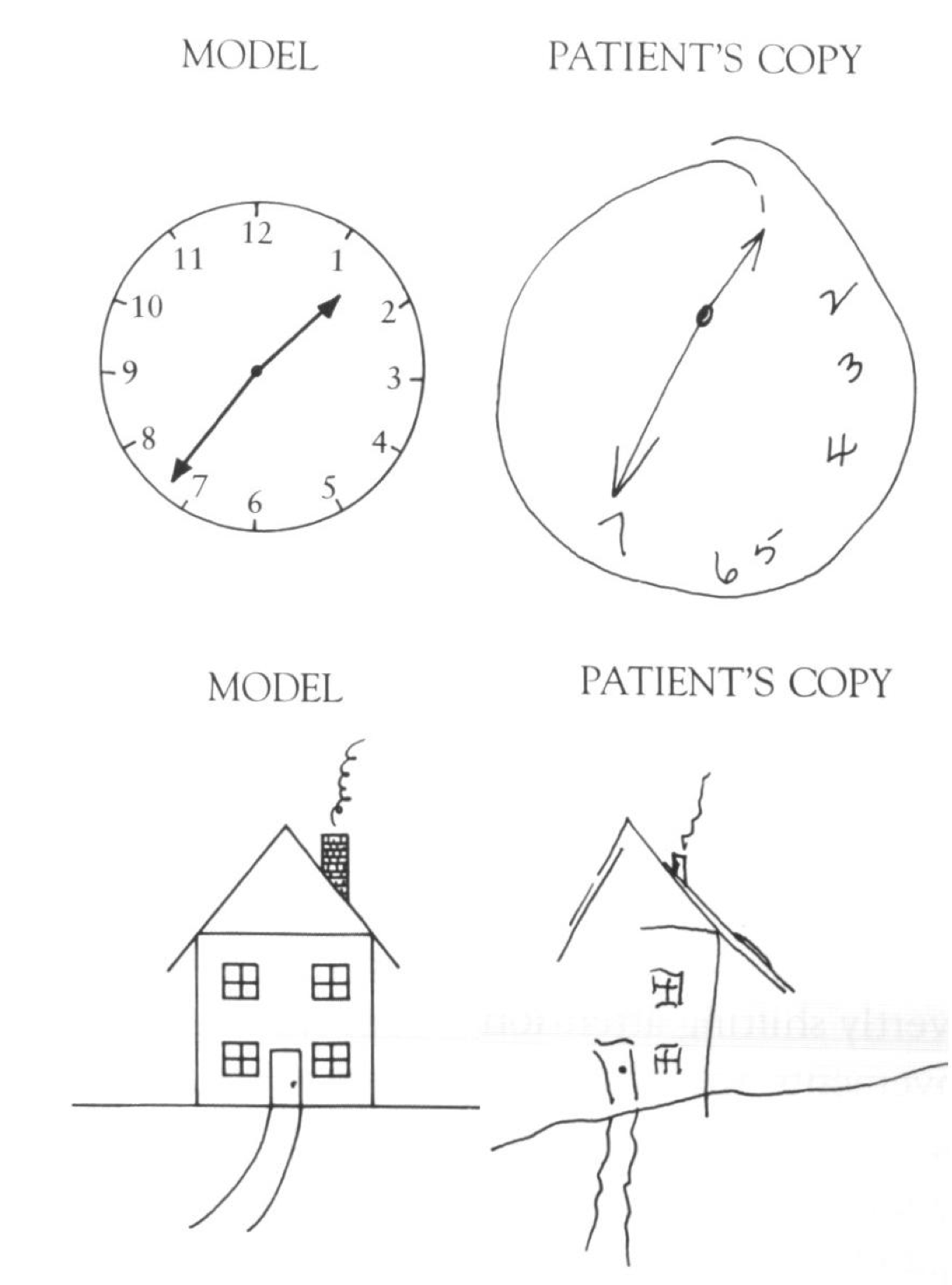Drawings of given target objects by patients with hemispatial neglect, showing profound neglect of the left side of the drawings.
