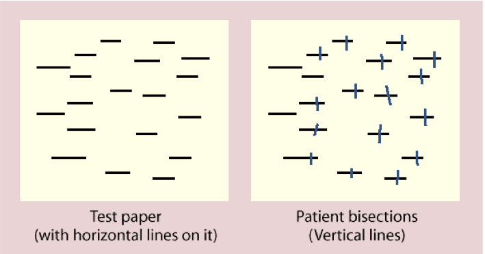 Results of a line bisection task for a person with hemispatial neglect. Notice that neglect appears to operate at two different spatial scales here: for the entire set of lines, and within each individual line.